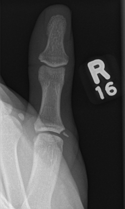 Radial Collateral Ligament Avulsion